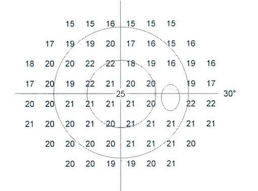 시야검사 예시