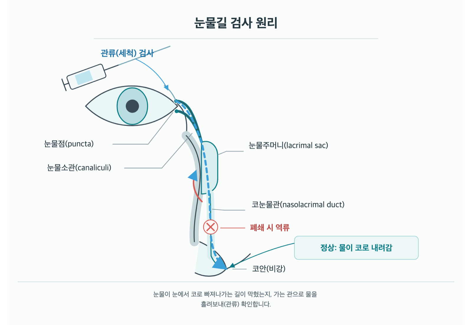 눈물이 자꾸 흐르는데, 눈물길 검사는 어떻게 하나요? 원리 도해