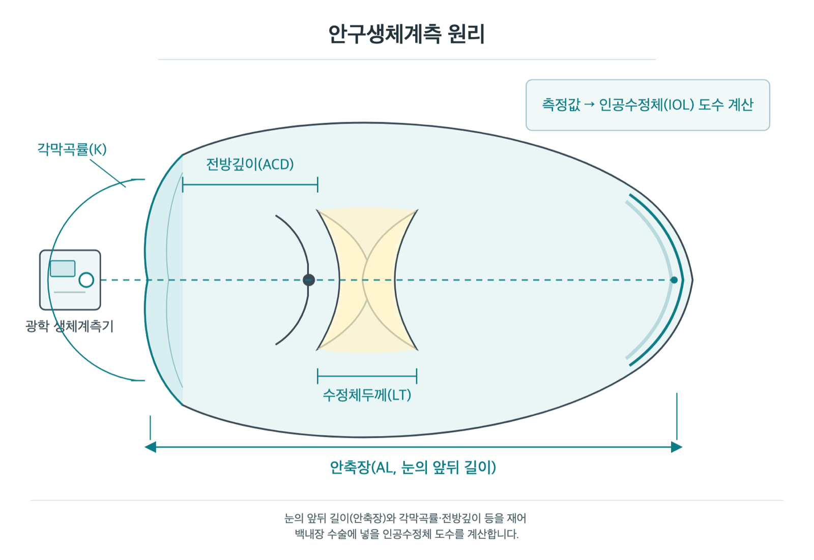 백내장 수술 전 안구생체계측, 왜 여러 번 잴까요? 원리 도해