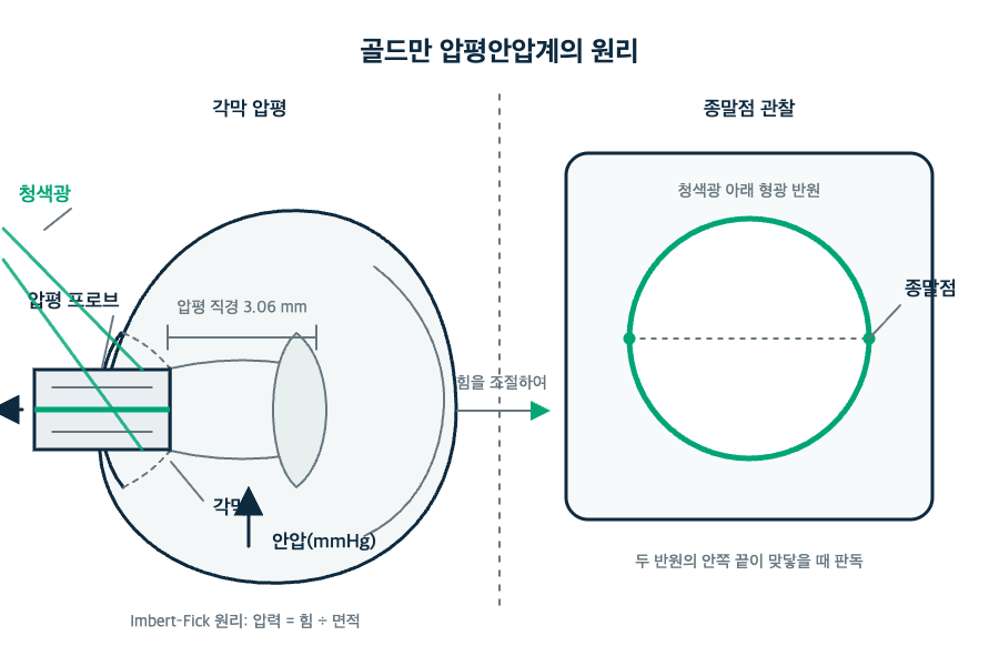 안압검사, 정상 수치면 녹내장 걱정을 놓아도 될까요? 원리 도해