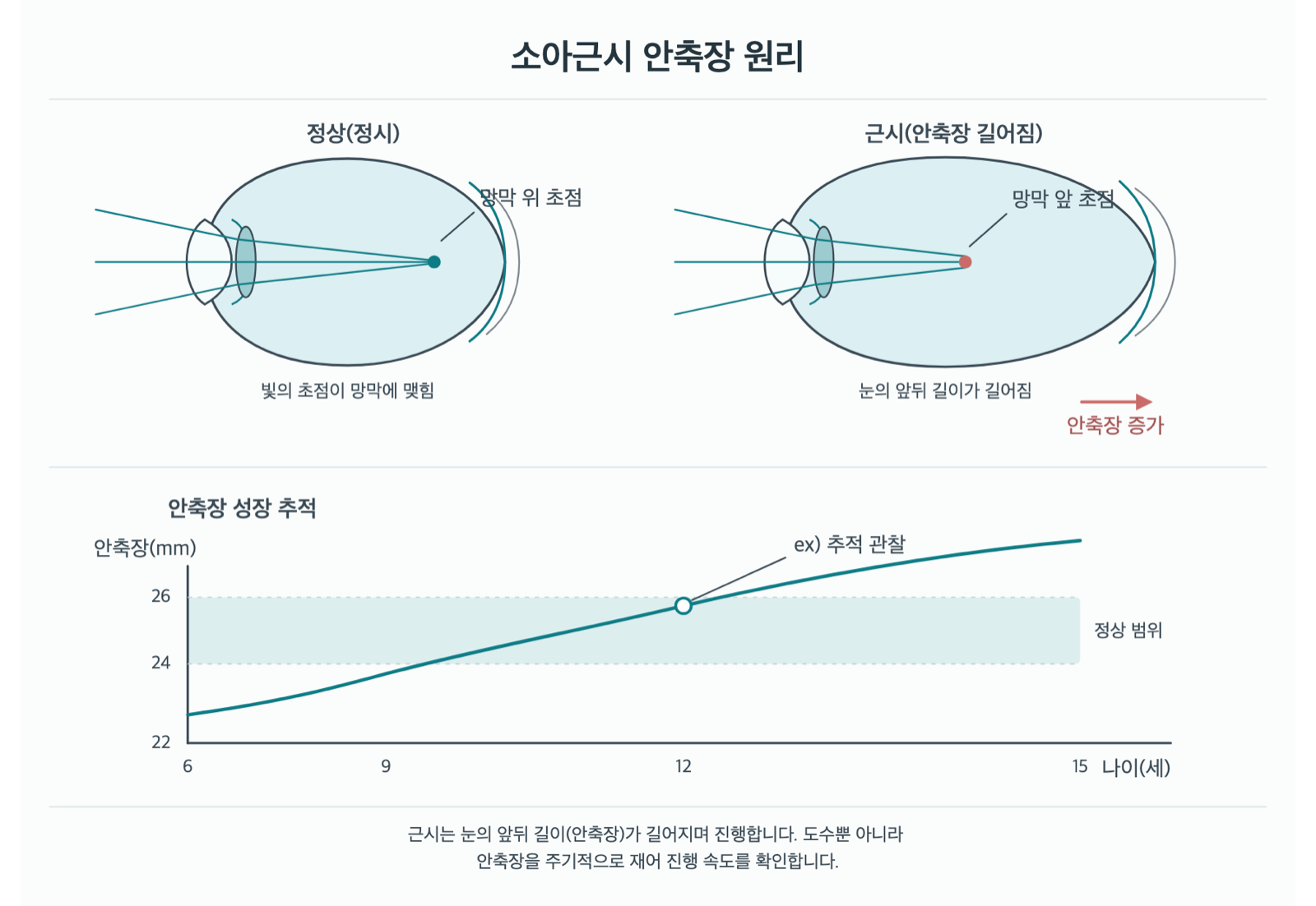 아이 근시, 안경 도수 말고 눈 길이도 재야 하나요? 원리 도해