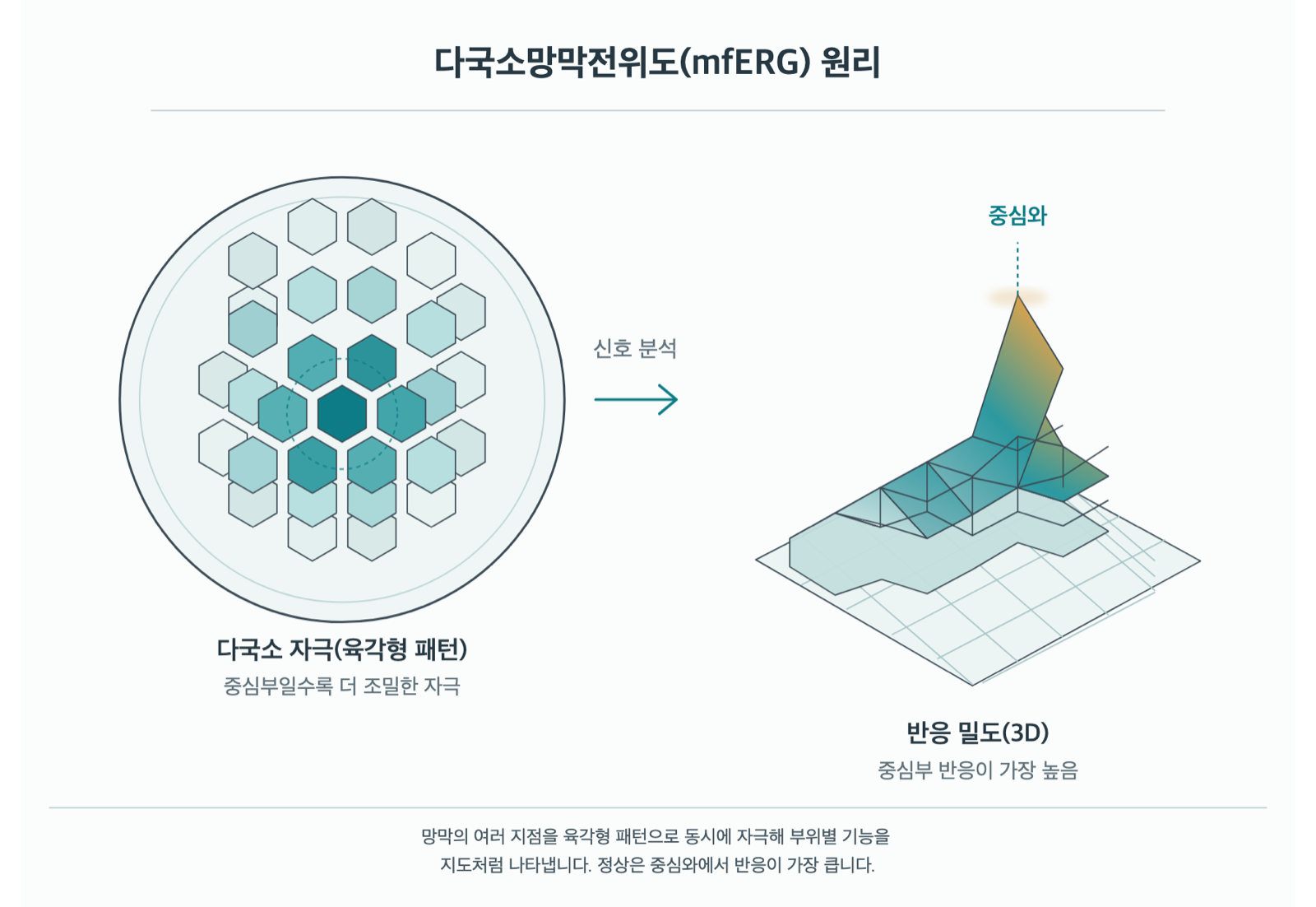 다국소망막전위도(mfERG), 무엇을 알아보는 검사인가요? 원리 도해