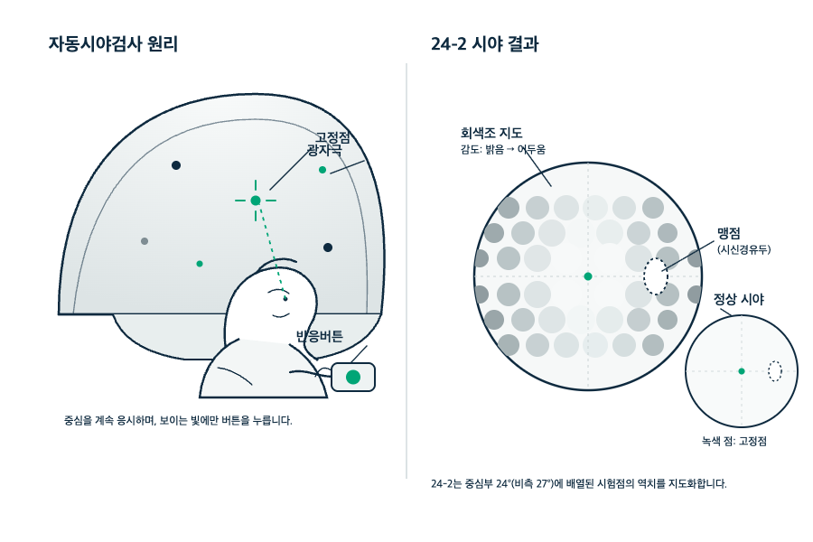시력은 좋은데 시야검사는 왜 받아야 할까요? 원리 도해